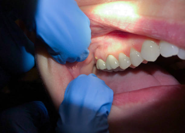 Best Tooth Infection Emergency Dentist  in Roselawn, IN