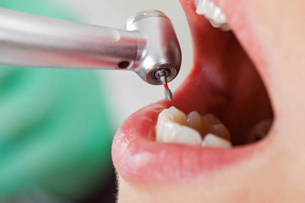 Best Dentist for Tooth Abscess  in Roselawn, IN